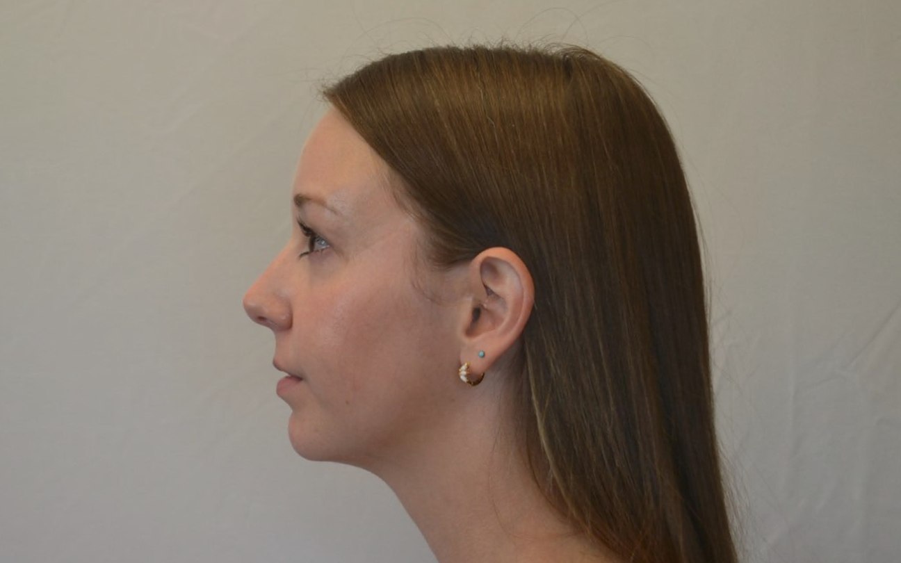 Left profile of the same patient after corrective jaw surgery, showing a more balanced, defined jaw and chin