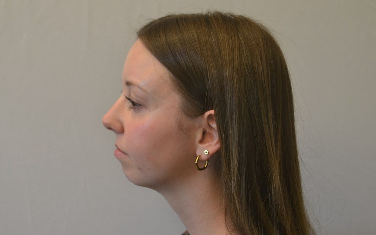 Left profile of a patient before corrective jaw surgery